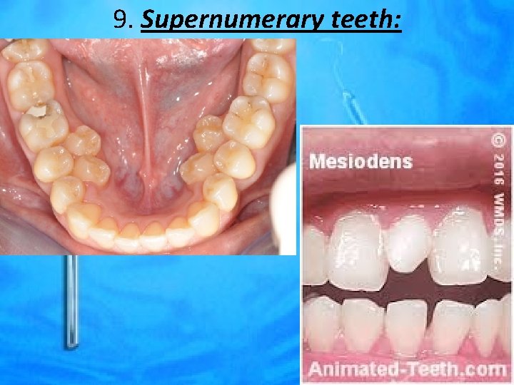 9. Supernumerary teeth: 
