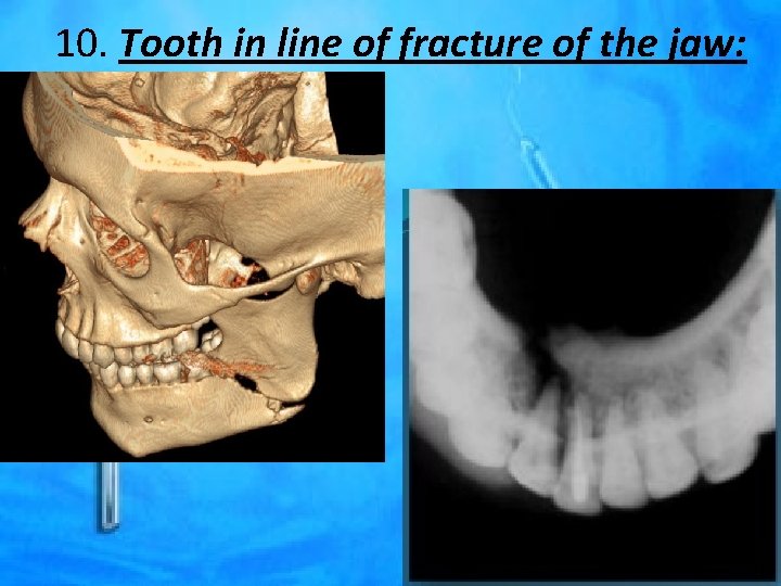 10. Tooth in line of fracture of the jaw: 