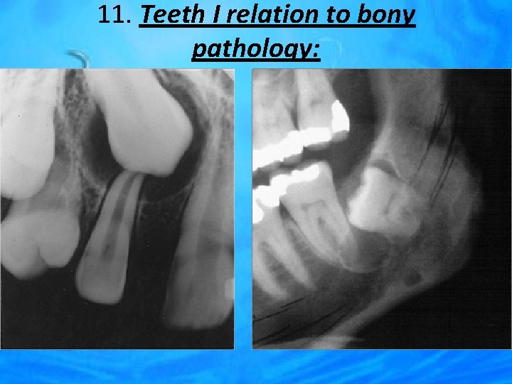 11. Teeth I relation to bony pathology: 