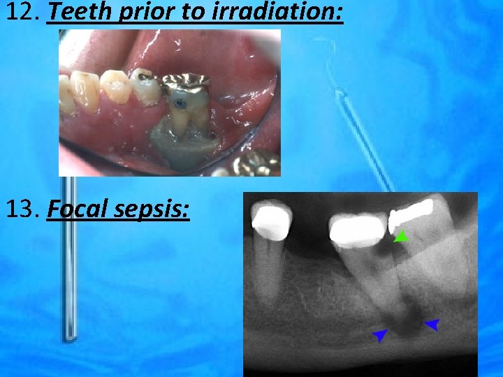 12. Teeth prior to irradiation: 13. Focal sepsis: 