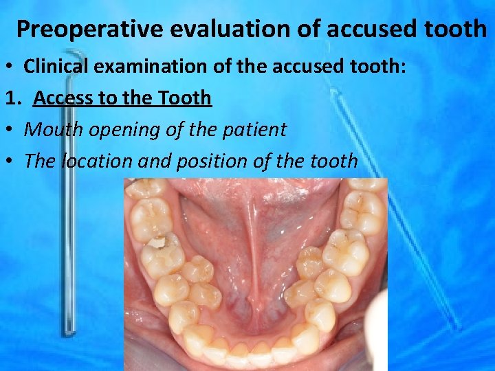Preoperative evaluation of accused tooth • Clinical examination of the accused tooth: 1. Access