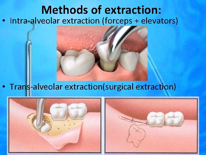 Methods of extraction: • Intra-alveolar extraction (forceps + elevators) • Trans-alveolar extraction(surgical extraction) 
