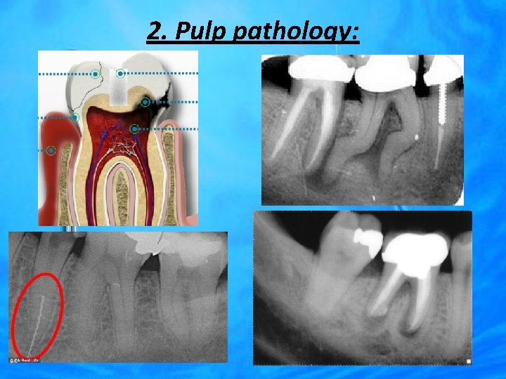 2. Pulp pathology: 