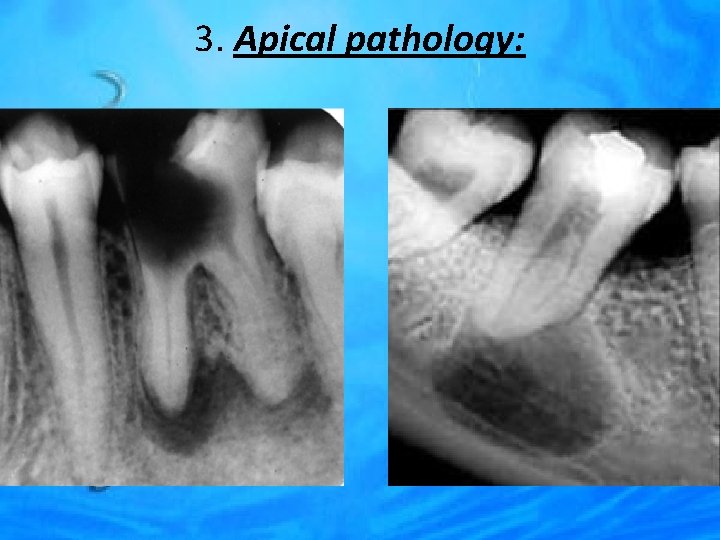 3. Apical pathology: 