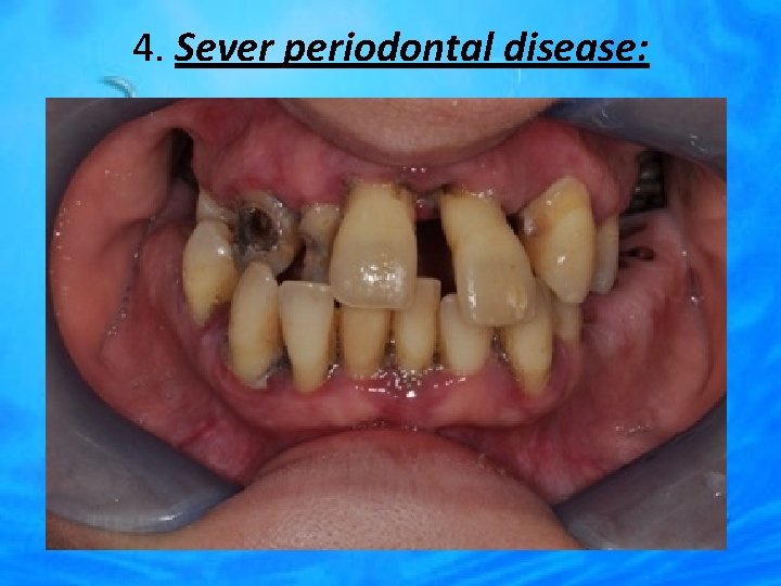 4. Sever periodontal disease: 