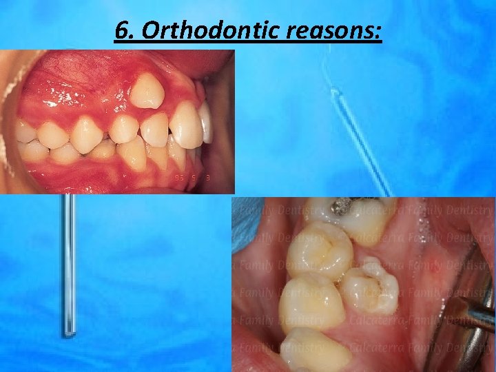 6. Orthodontic reasons: 