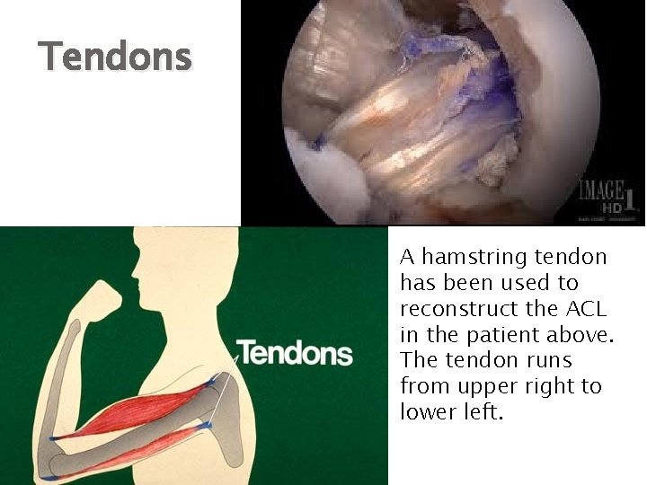 Tendons A hamstring tendon has been used to reconstruct the ACL in the patient