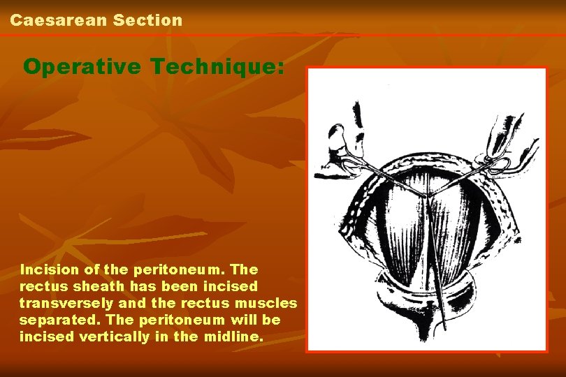 Caesarean Section Operative Technique: Incision of the peritoneum. The rectus sheath has been incised