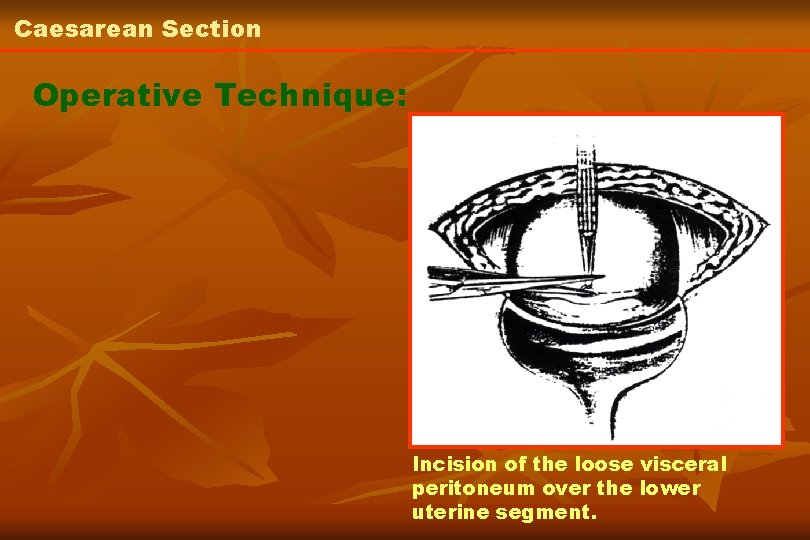 Caesarean Section Operative Technique: Incision of the loose visceral peritoneum over the lower uterine