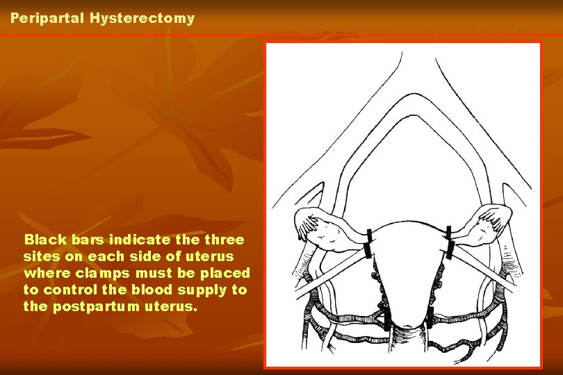 Peripartal Hysterectomy Black bars indicate three sites on each side of uterus where clamps