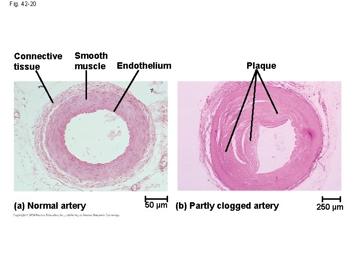 Fig. 42 -20 Connective tissue Smooth muscle (a) Normal artery Endothelium Plaque 50 µm