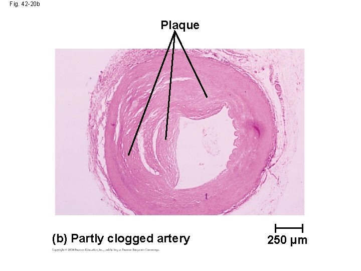 Fig. 42 -20 b Plaque (b) Partly clogged artery 250 µm 