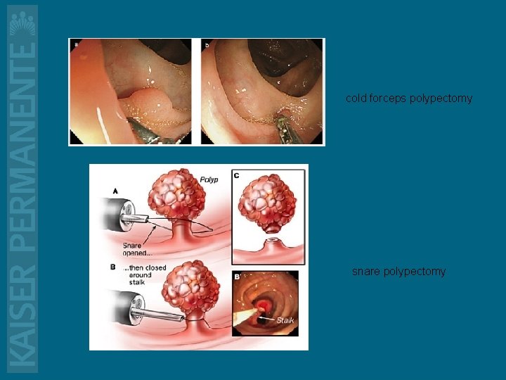 cold forceps polypectomy snare polypectomy 