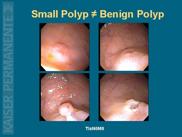 Small Polyp ≠ Benign Polyp Tis. N 0 M 0 