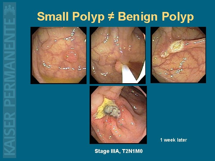 Small Polyp ≠ Benign Polyp 1 week later Stage IIIA, T 2 N 1