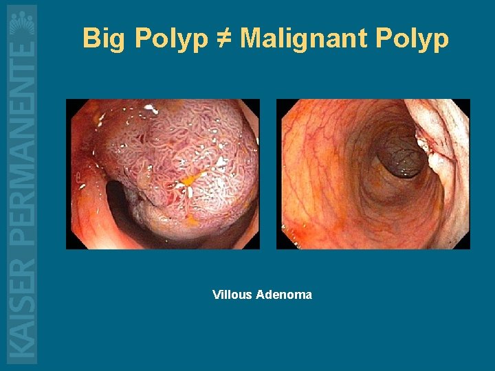 Big Polyp ≠ Malignant Polyp Villous Adenoma 