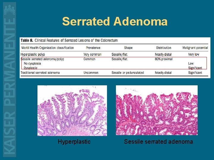 Serrated Adenoma Hyperplastic Sessile serrated adenoma 