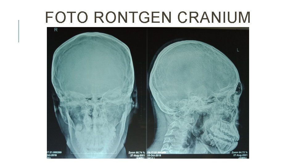 FOTO RONTGEN CRANIUM 