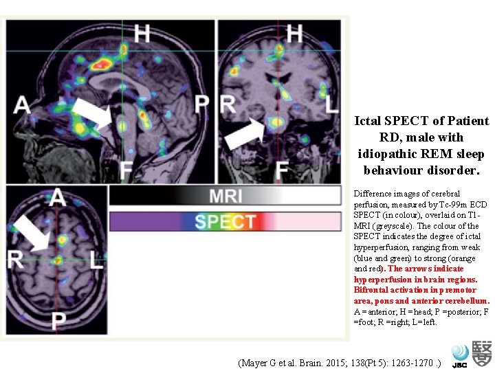 Ictal SPECT of Patient RD, male with idiopathic REM sleep behaviour disorder. Difference images