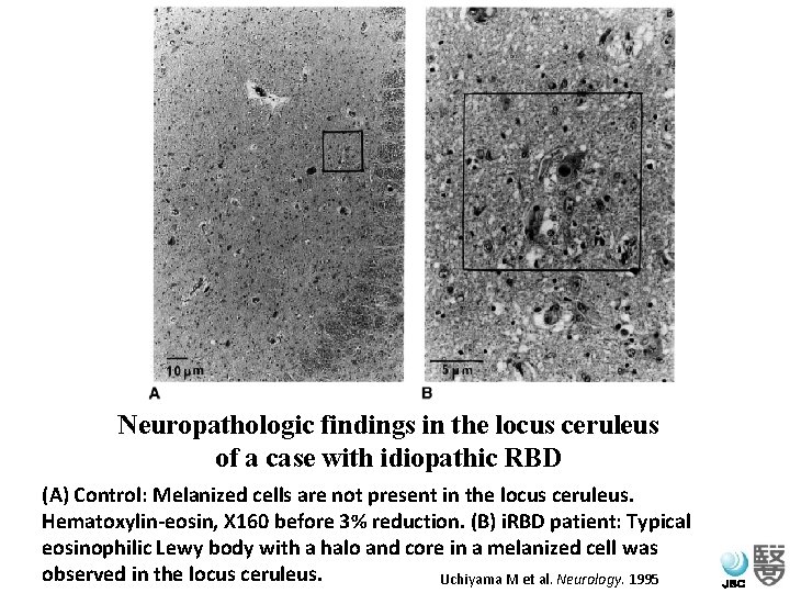 Neuropathologic findings in the locus ceruleus of a case with idiopathic RBD (A) Control: