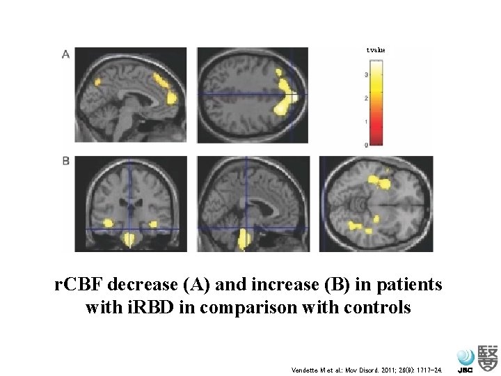 t value r. CBF decrease (A) and increase (B) in patients with i. RBD