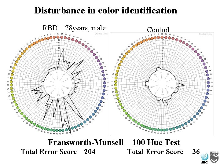 Disturbance in color identification RBD　78 years, male Control Fransworth-Munsell　100 Hue Test Total Error Score　204