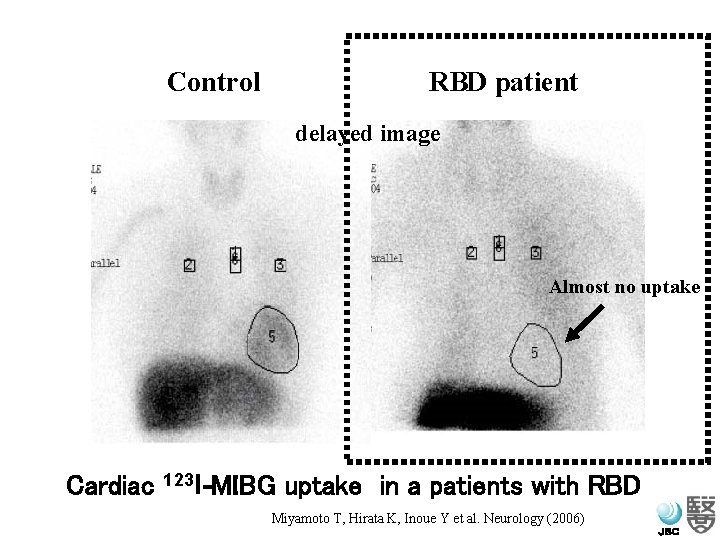 Control　　　　　　RBD patient delayed image Almost no uptake 　Cardiac 123 I-MIBG uptake in a patients