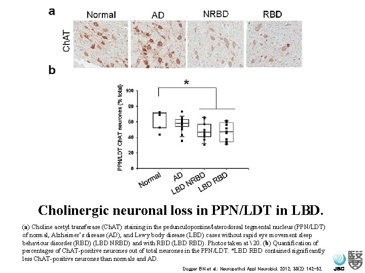 Cholinergic neuronal loss in PPN/LDT in LBD. (a) Choline acetyl transferase (Ch. AT) staining