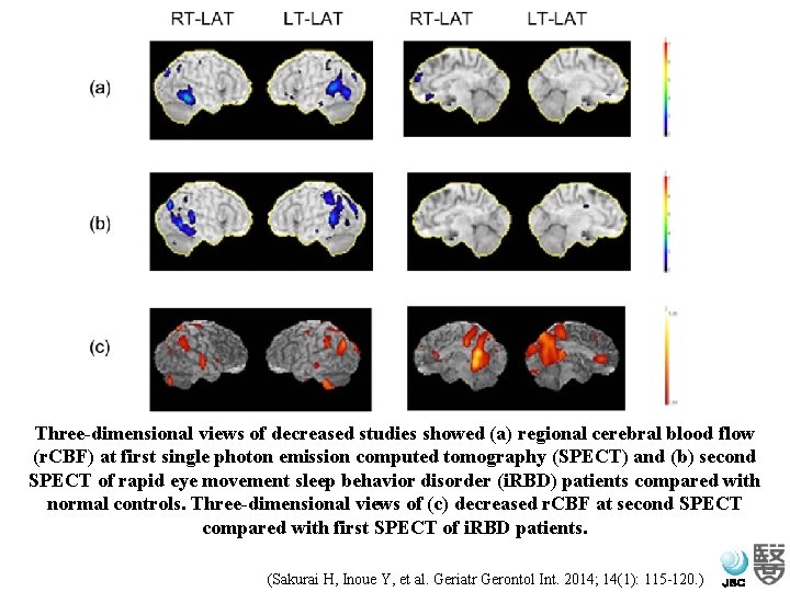 Three-dimensional views of decreased studies showed (a) regional cerebral blood flow (r. CBF) at