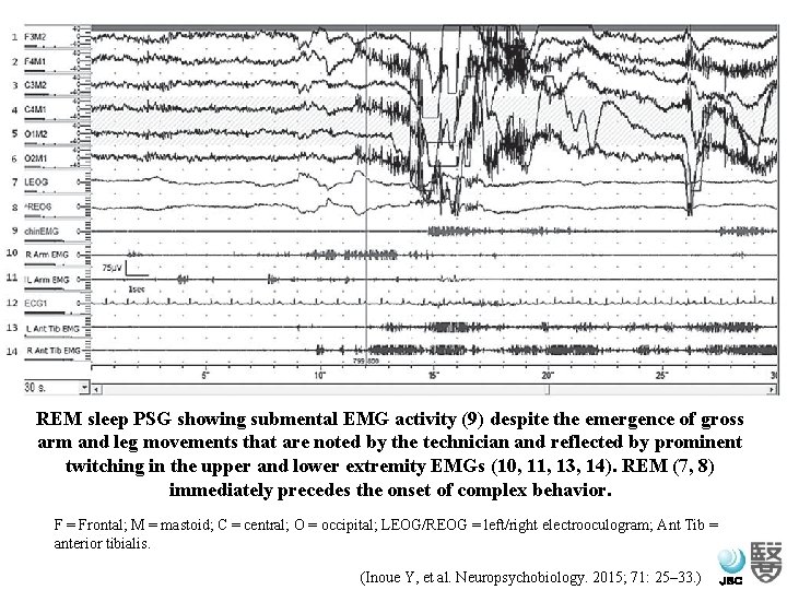 REM sleep PSG showing submental EMG activity (9) despite the emergence of gross arm