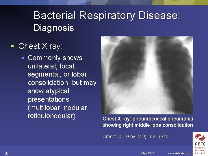 Bacterial Respiratory Disease: Diagnosis § Chest X ray: § Commonly shows unilateral, focal, segmental,