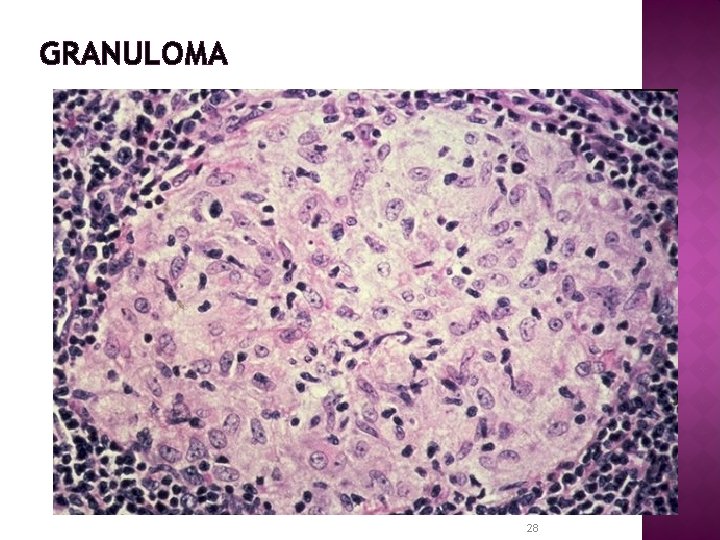 GRANULOMA 28 