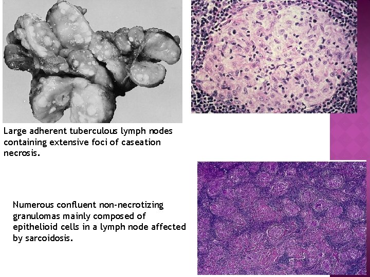Large adherent tuberculous lymph nodes containing extensive foci of caseation necrosis. Numerous confluent non-necrotizing