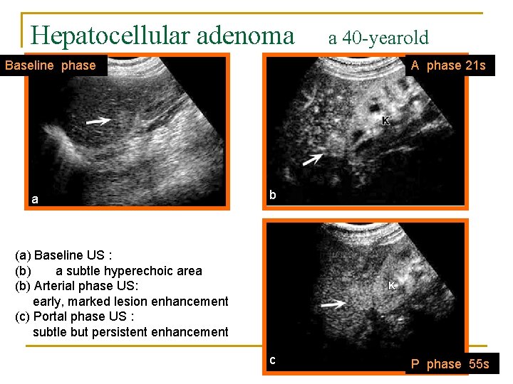 Hepatocellular adenoma woman Baseline phase a a 40 -yearold A phase 21 s b