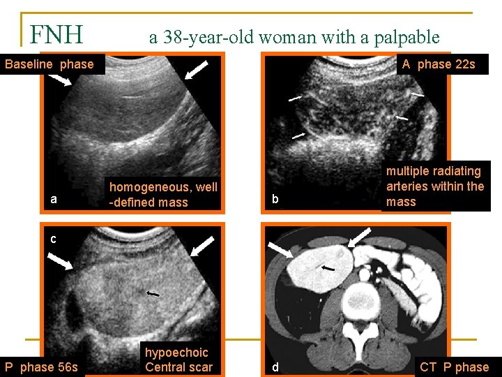 FNH a 38 -year-old woman with a palpable massphase Baseline a A phase 22