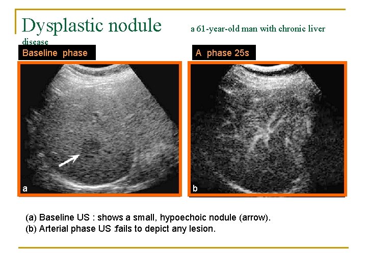 Dysplastic nodule disease Baseline phase a a 61 -year-old man with chronic liver A