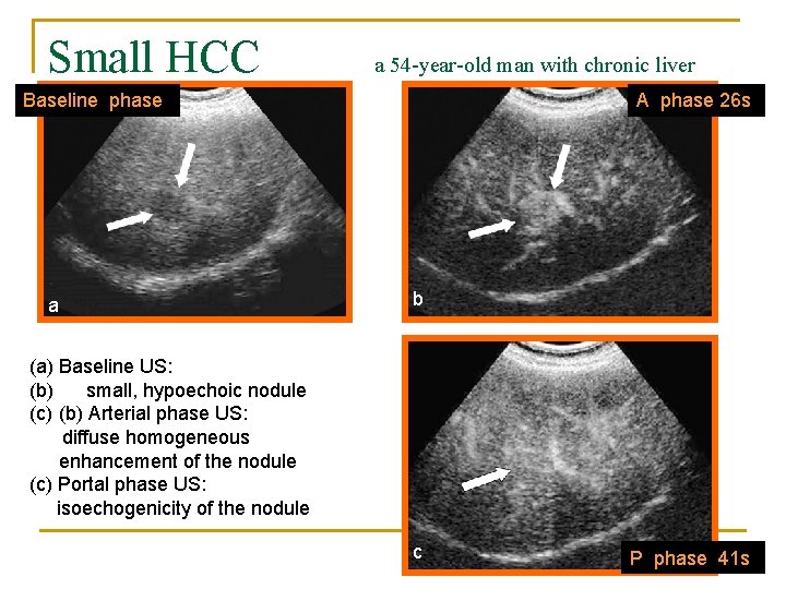 Small HCC a 54 -year-old man with chronic liver diseasephase Baseline a A phase
