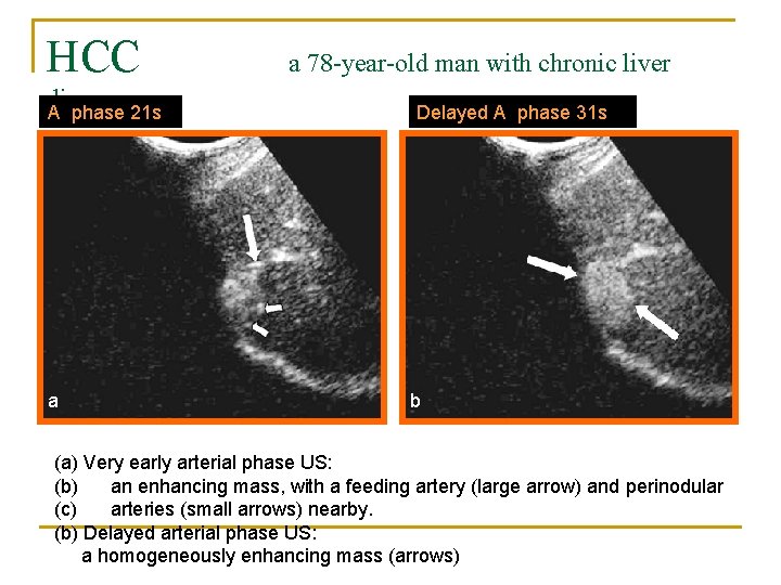 HCC disease A phase 21 s a a 78 -year-old man with chronic liver
