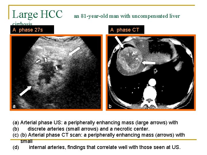 Large HCC cirrhosis A phase 27 s a an 81 -year-old man with uncompensated