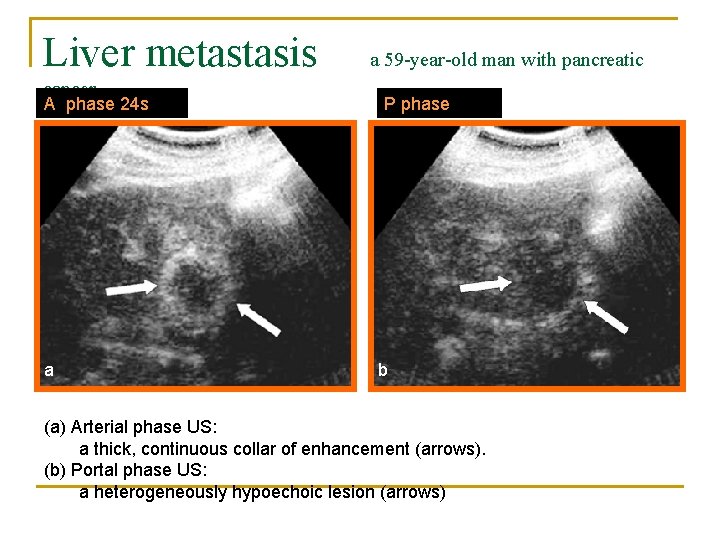 Liver metastasis cancer A phase 24 s a a 59 -year-old man with pancreatic