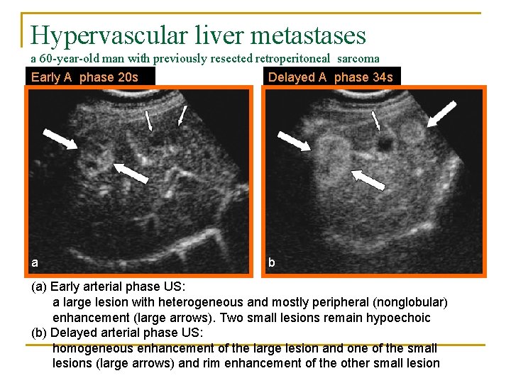 Hypervascular liver metastases a 60 -year-old man with previously resected retroperitoneal sarcoma Early A