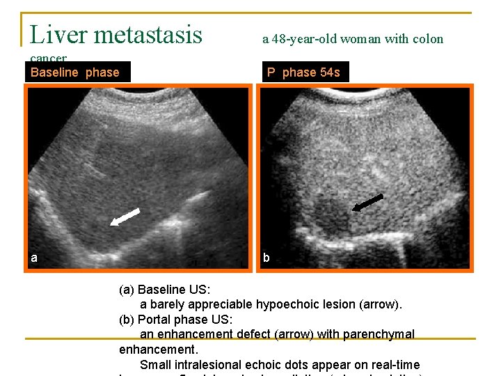 Liver metastasis cancer Baseline phase a a 48 -year-old woman with colon P phase