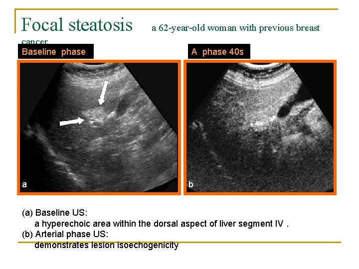 Focal steatosis cancer Baseline phase a a 62 -year-old woman with previous breast A