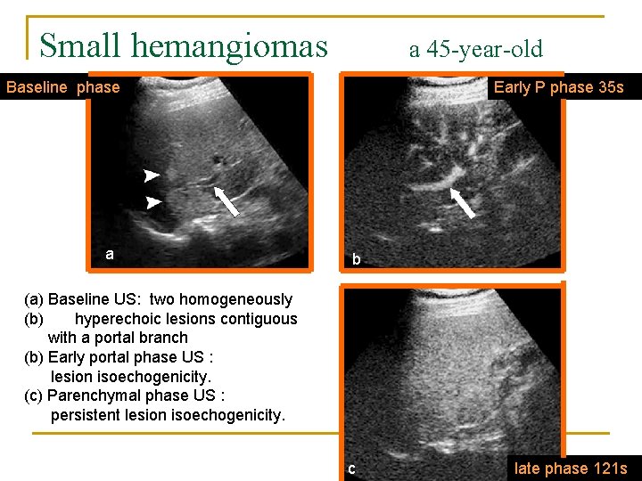 Small hemangiomas a 45 -year-old woman Baseline phase a Early P phase 35 s