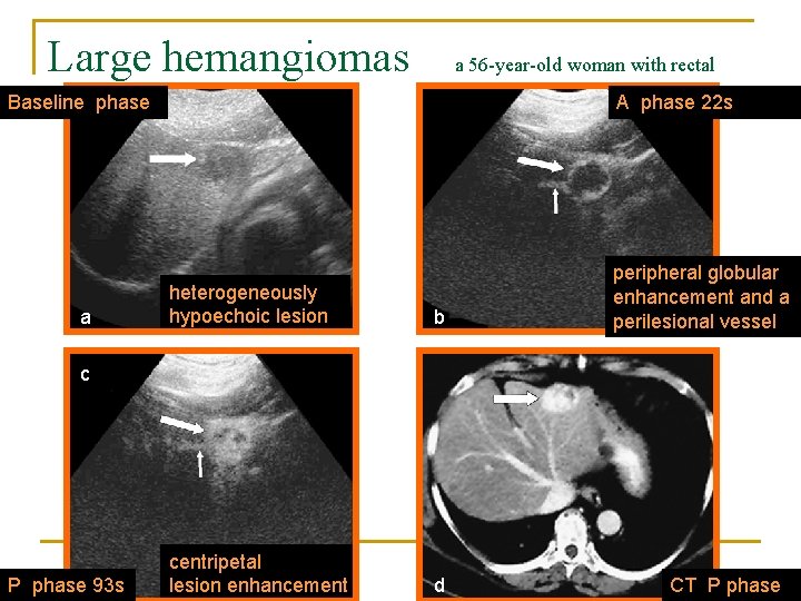 Large hemangiomas a 56 -year-old woman with rectal cancerphase Baseline a A phase 22