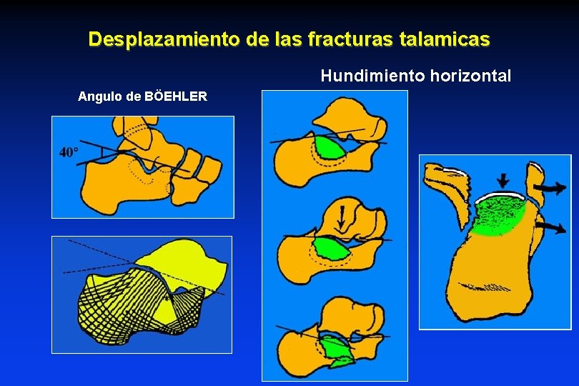 Desplazamiento de las fracturas talamicas Hundimiento horizontal Angulo de BÖEHLER Desplazamiento de las fracturas talamicas Hundimiento horizontal Angulo de BÖEHLER