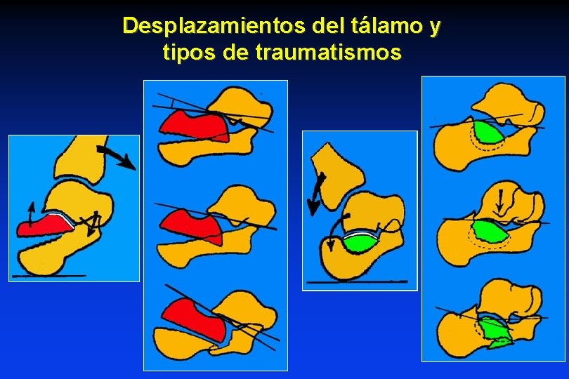Desplazamientos del tálamo y tipos de traumatismos Desplazamientos del tálamo y tipos de traumatismos