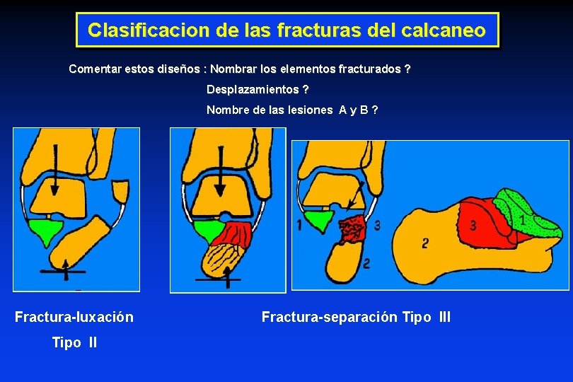 Clasificacion de las fracturas del calcaneo Comentar estos diseños : Nombrar los elementos fracturados Clasificacion de las fracturas del calcaneo Comentar estos diseños : Nombrar los elementos fracturados