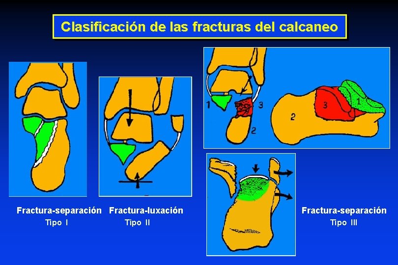 Clasificación de las fracturas del calcaneo Fractura-separación Fractura-luxación Tipo II Fractura-separación Tipo III Clasificación de las fracturas del calcaneo Fractura-separación Fractura-luxación Tipo II Fractura-separación Tipo III