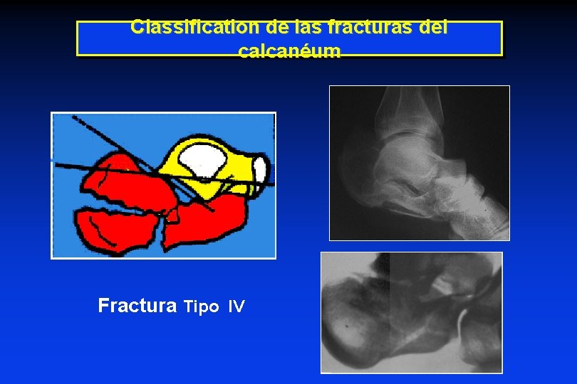 Classification de las fracturas del calcanéum Fractura Tipo IV Classification de las fracturas del calcanéum Fractura Tipo IV